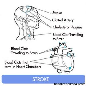 early signs and symptoms of pending stroke