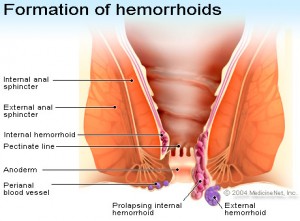 how to deal with bleeding hemorrhoids