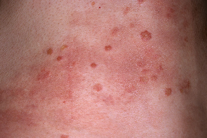 Hiv Rash Picture Types And Home Treatment