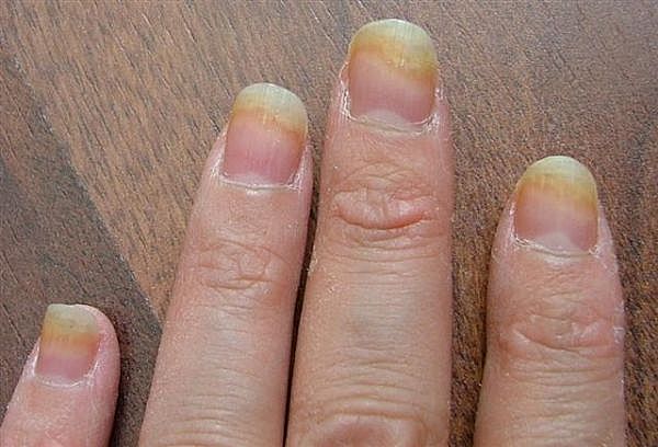 Fingernail Fungus Causes Picture Symptoms And Treatment