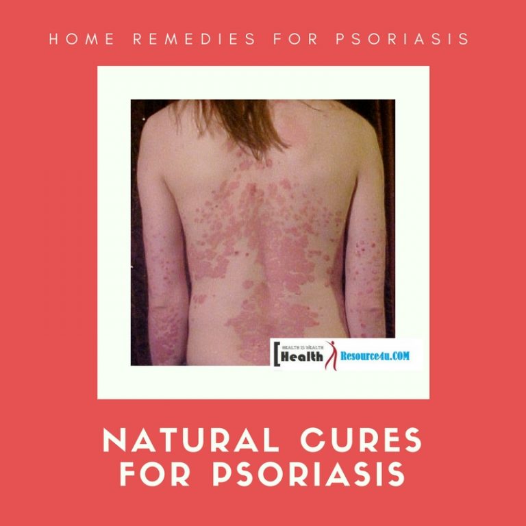 Best Natural Cures For Psoriasis Symptoms