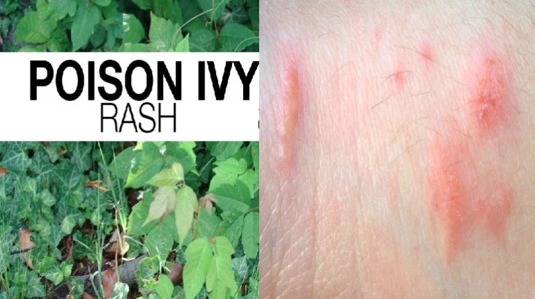 poison-oak-rash-signs-symptoms-causes-and-prevention