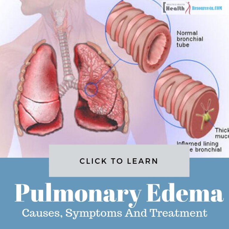 Pulmonary Edema