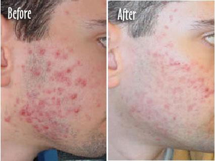 Important Facts About Acne Scars : Treatment And Home Remedies