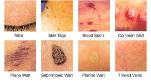 Warts Types, Symptoms, Treatment And Its Preventing Measures