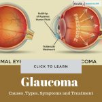 Glaucoma Causes treatment