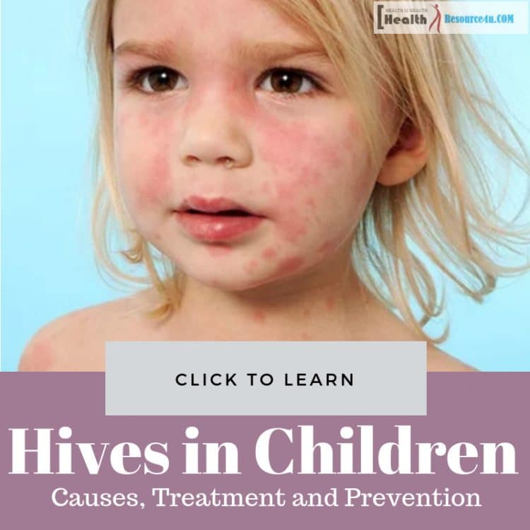 Hives In Children Causes Picture Symptoms And Treatment