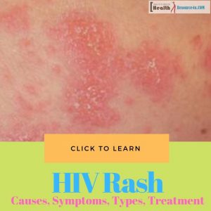 HIV Rash - Causes, Picture, Symptoms, Types, Home Treatment