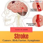 Stroke - Causes, Risk Factor, Symptoms And Treatment