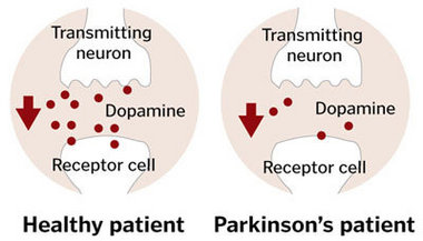 Parkinson’s Disease : Causes, Symptoms And Treatment