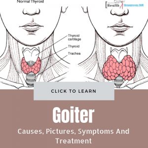 Goiter - Causes, Pictures, Symptoms And Treatment