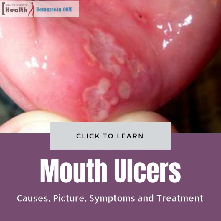 Mouth Ulcers Causes Picture Symptoms And Treatment