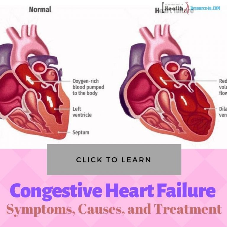 Congestive Heart Failure : Symptoms, Causes, And Treatment