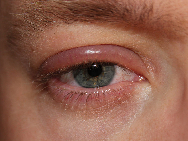 Swollen Eyelids Causes Pictures Symptoms And Treatment