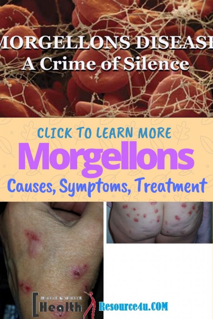 Morgellons Disease - Causes, Picture, Symptoms And Treatment