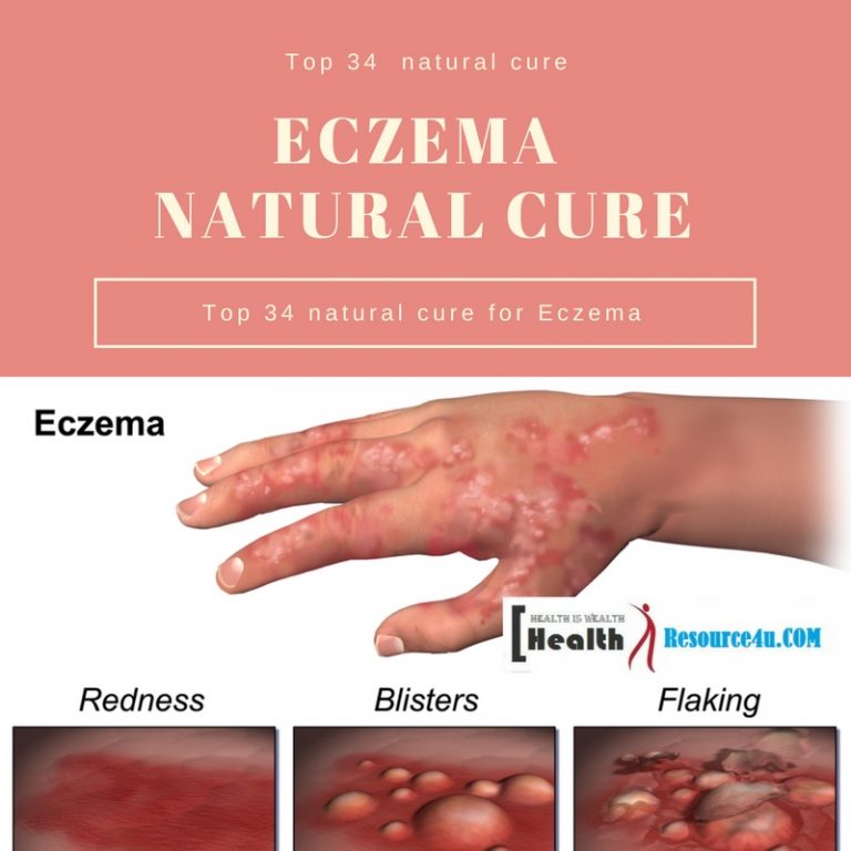 Eczema : Symptoms and Natural Remedies