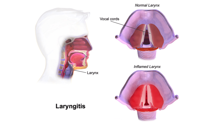 Laryngitis Causes Picture Symptoms And Treatment