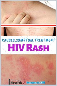 HIV Rash - Causes, Picture, Symptoms, Types, Home Treatment