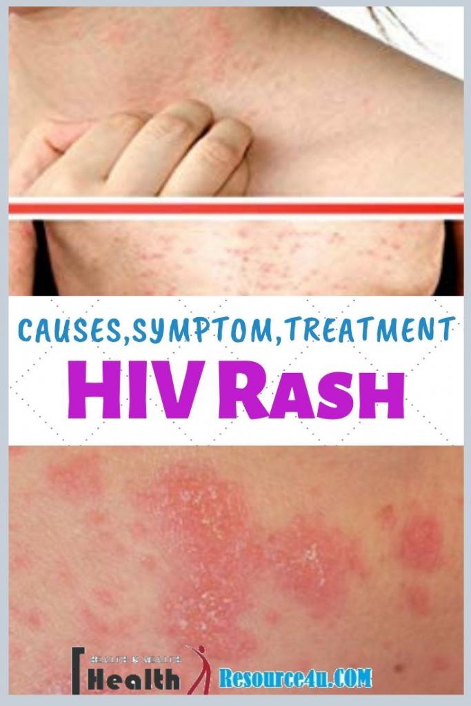 Hiv Rash Causes Picture Symptoms Types Home Treatment 5225
