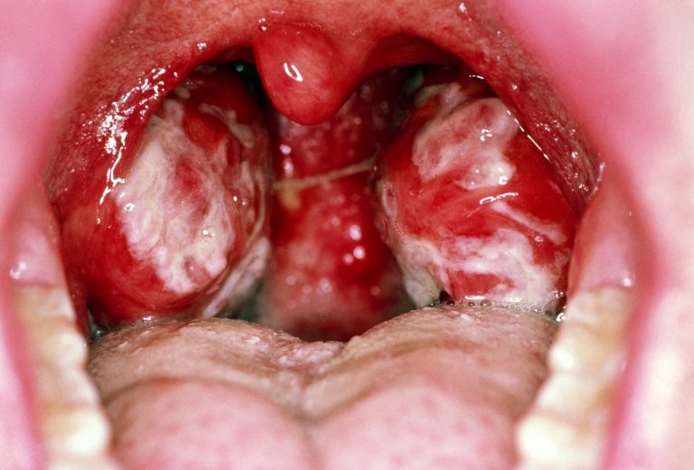 Kissing Disease : Causes, Symptoms, Treatment Of Mononucleosis